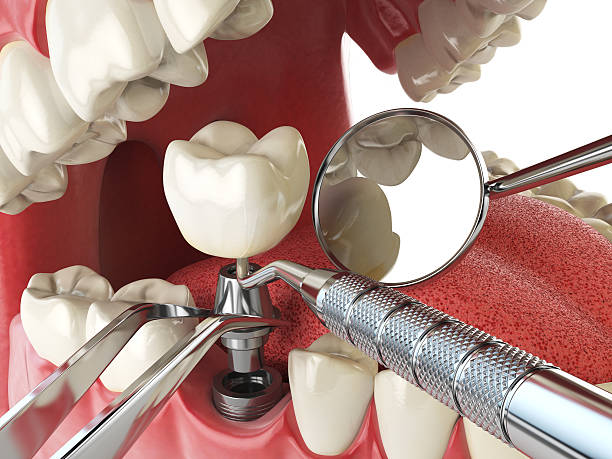 Best Lost Filling or Crown Replacement in Edinburg, IL